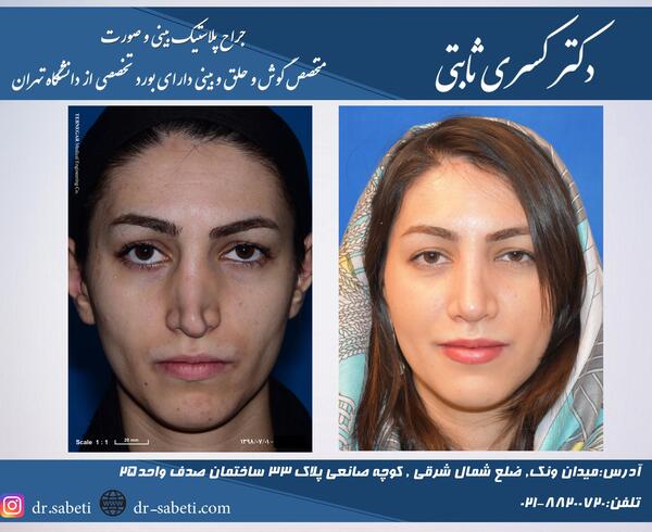 عکس صدف بیوتی قبل عمل