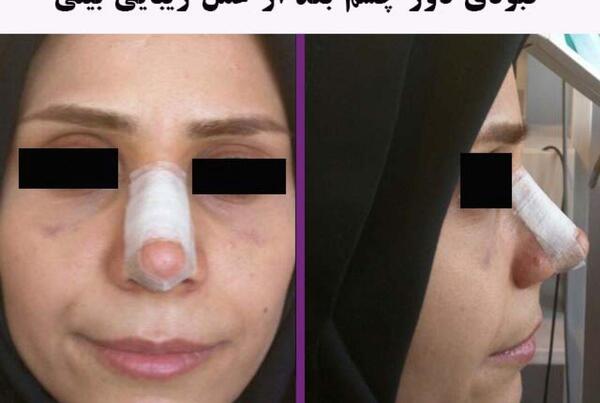 عکس صورت کبود