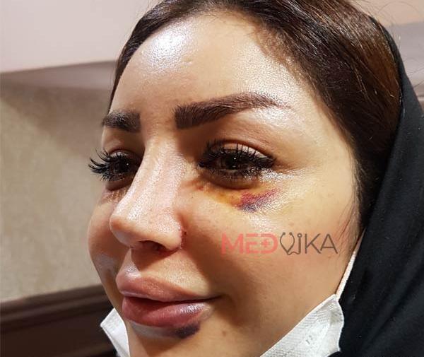 عکس کبودی صورت بعد از عمل بینی