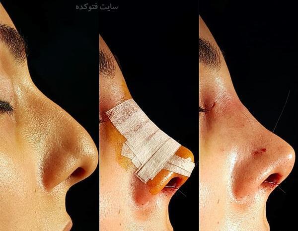 عکس کبودی صورت بعد از عمل بینی