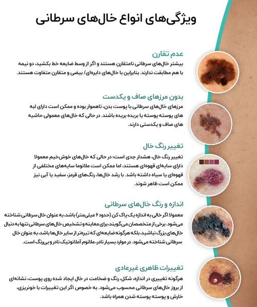 عکس خالهای گوشتی سرطانی
