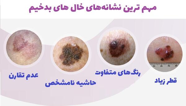 عکس خالهای گوشتی سرطانی