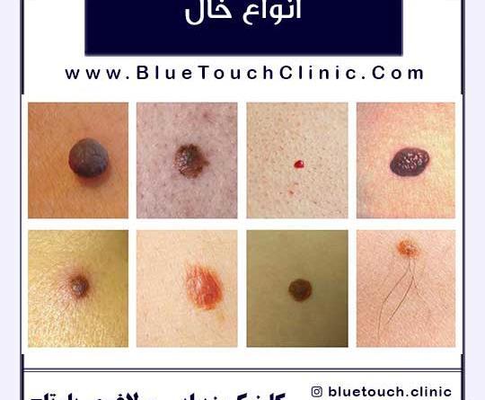 عکس خالهای گوشتی سرطانی