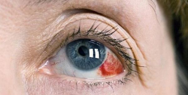 عکس چشم های قرمز