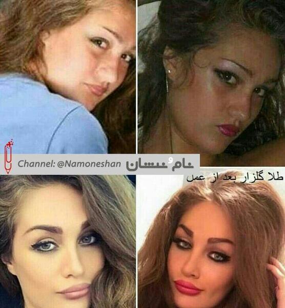 عکس طلا گلزار قبل از عمل زیبایی
