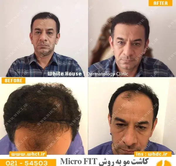 عکس شهاب حسینی قبل از کاشت مو