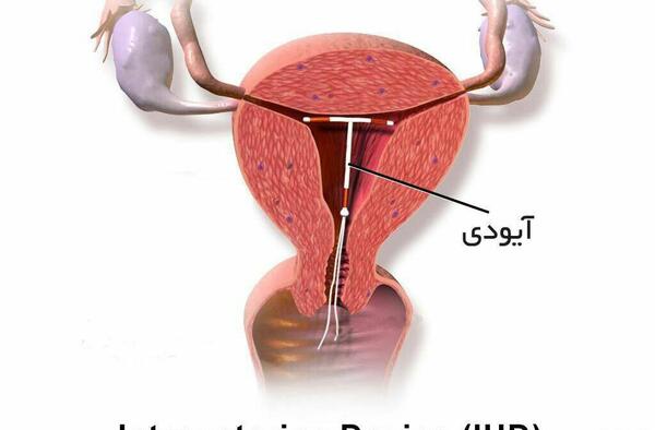 عکس دستگاه ضد بارداری
