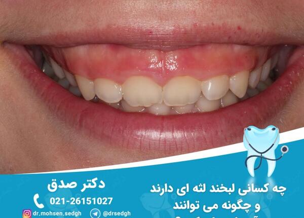 عکس لبخند لثه ای