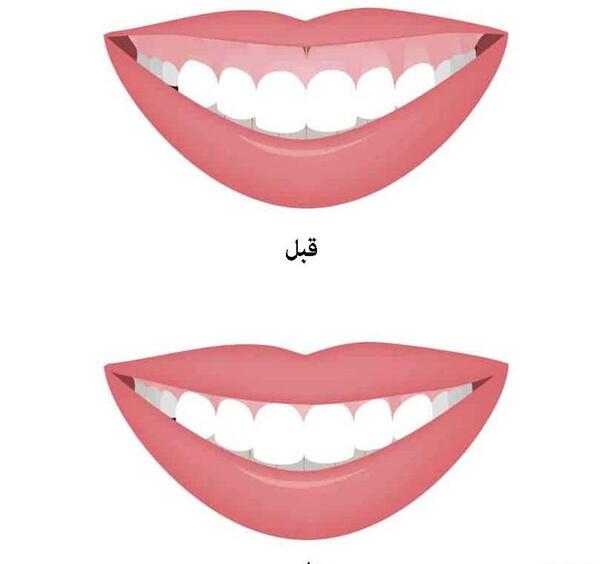 عکس لبخند لثه ای