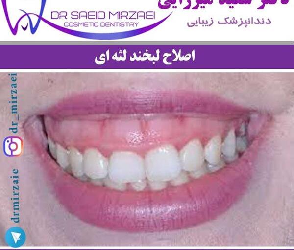 عکس لبخند لثه ای
