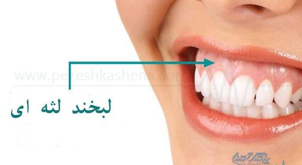 عکس لبخند لثه ای