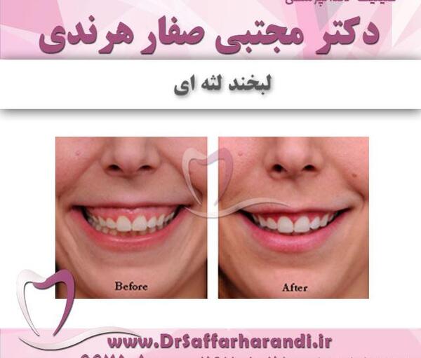 عکس لبخند لثه ای