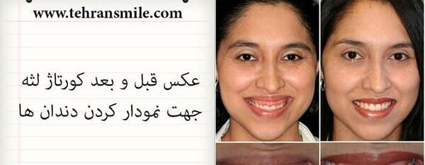 عکس لبخند لثه ای