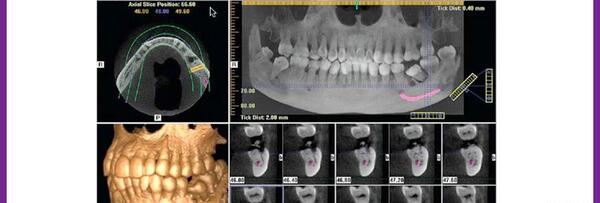 عکس سه بعدی دندان