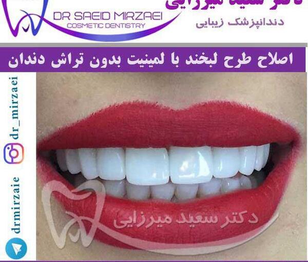 عکس طرح لبخند دندان