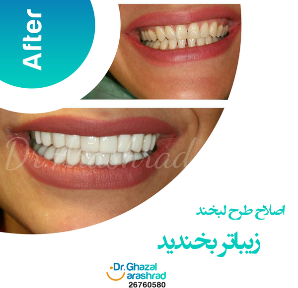 عکس طرح لبخند دندان