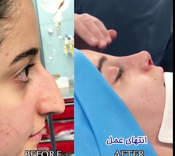 عکس قبل از عمل ایرم دریجی