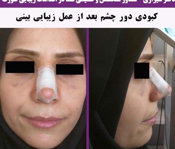 عکس کبودی عمل بینی