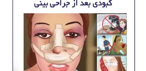 عکس کبودی عمل بینی
