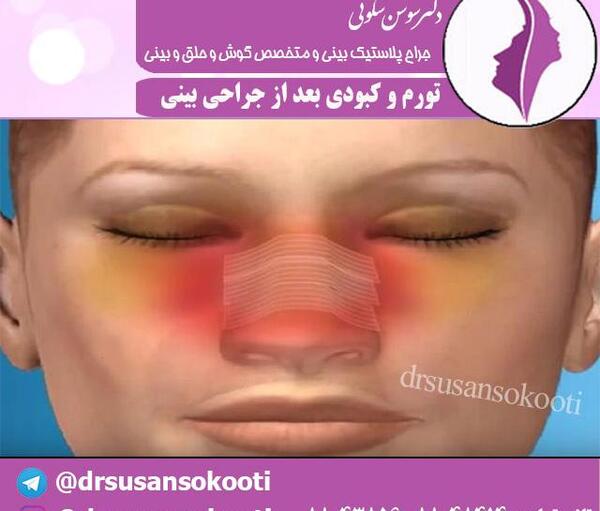 عکس کبودی عمل بینی