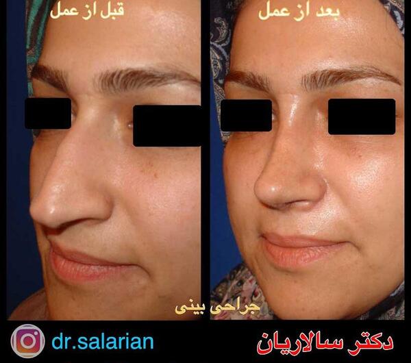 عکس قبل و بعد عمل بینی