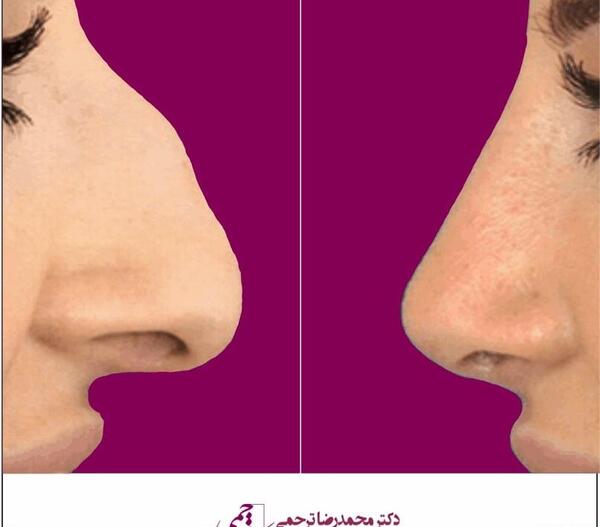 عکس قبل و بعد عمل بینی