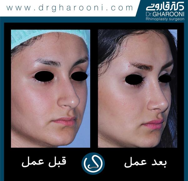 عکس قبل و بعد عمل بینی