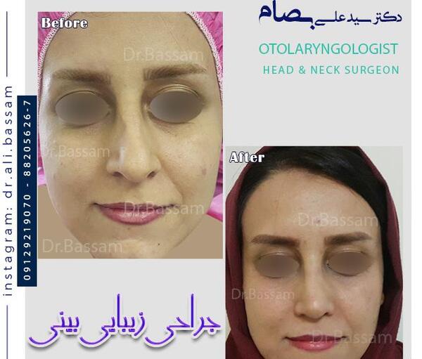 عکس قبل و بعد عمل بینی