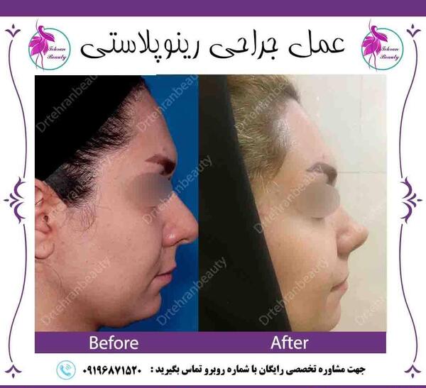 عکس قبل و بعد عمل بینی