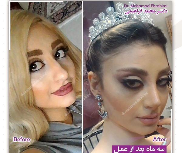 عکس قبل و بعد عمل بینی