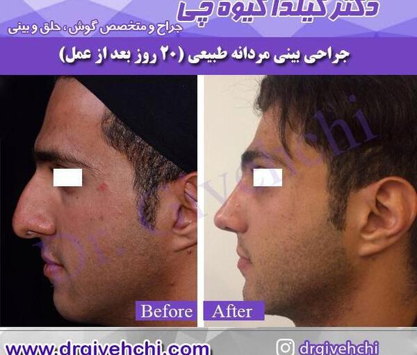 عکس قبل و بعد عمل بینی