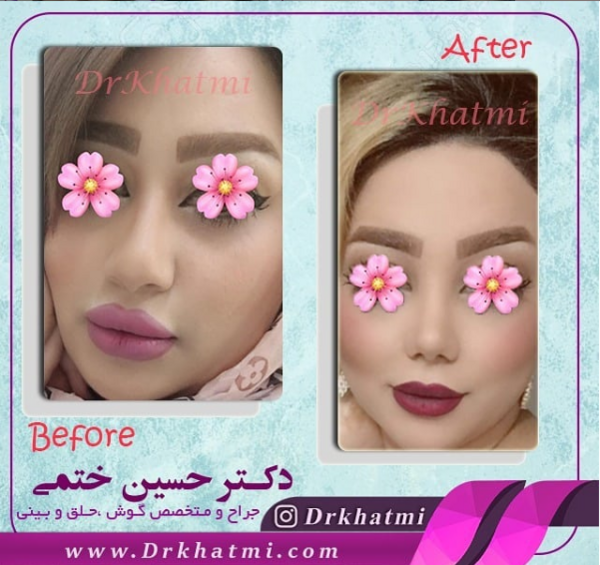 عکس قبل و بعد عمل بینی