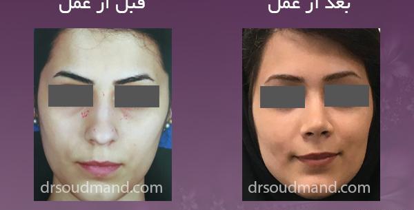 عکس قبل و بعد عمل بینی