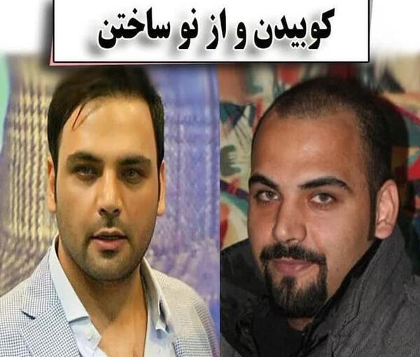 عکس قبل کاشت مو احسان علیخانی