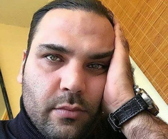 عکس قبل کاشت مو احسان علیخانی