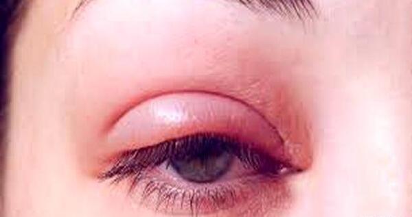 عکس چشم قرمز شده