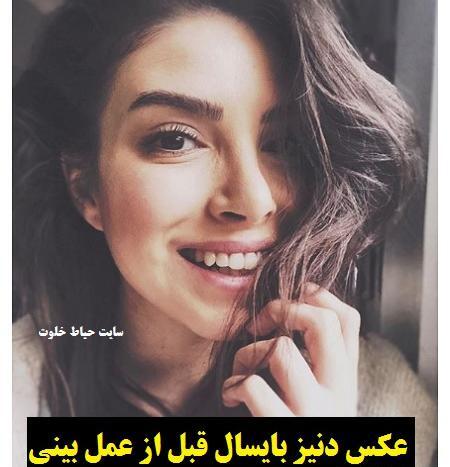 عکس دنیز بایسال قبل از عمل بینی