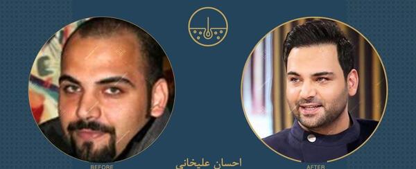 عکس قبل از کاشت مو احسان علیخانی