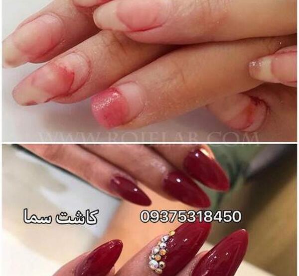 عکس قبل کاشت ناخن