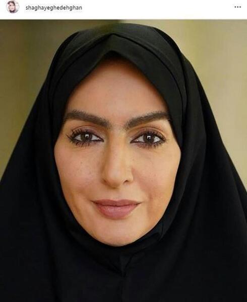 عکس شقایق دهقان قبل و بعد عمل