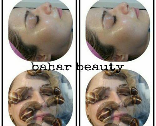 عکس قبل و بعد حلزون تراپی