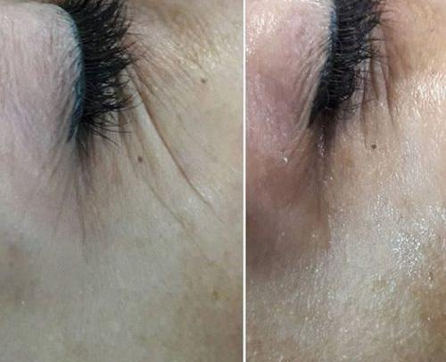 عکس قبل و بعد حلزون تراپی