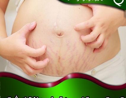 عکس قبل و بعد حلزون تراپی