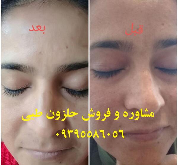 عکس قبل و بعد حلزون تراپی