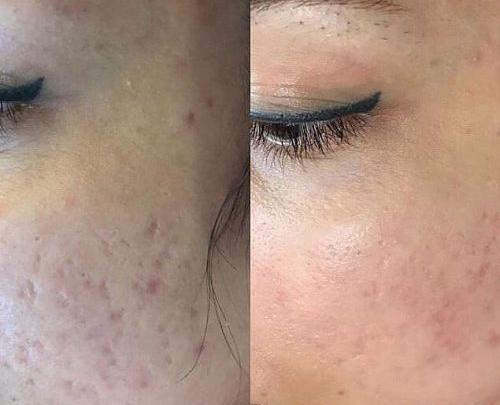 عکس قبل و بعد حلزون تراپی