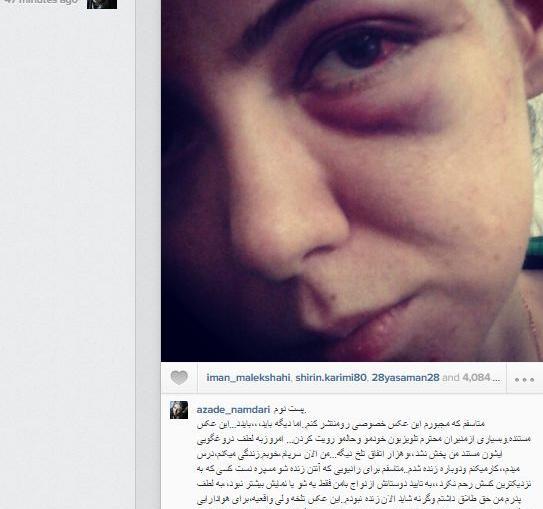 عکس کبودی زیر چشم آزاده نامداری