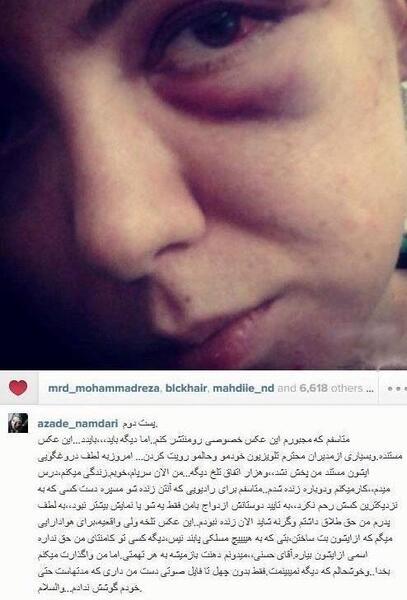 عکس کبودی زیر چشم آزاده نامداری