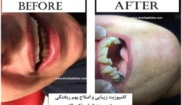 عکس کامپوزیت قبل و بعد