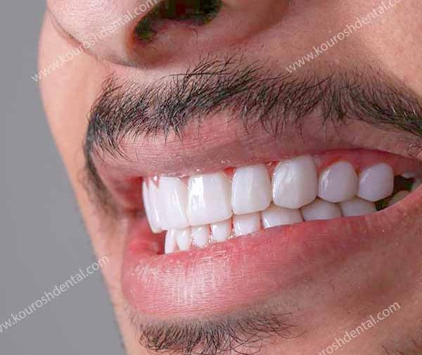 عکس کامپوزیت قبل و بعد