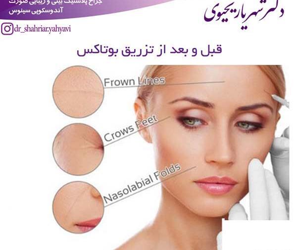 عکس بوتاکس صورت قبل و بعد